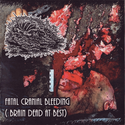 Botched Anastomosis J-Pouch : Fatal Cranial Bleeding (Brain Dead at Best)